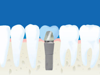 インプラント